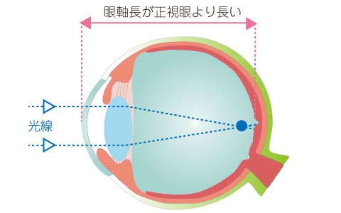 軸性近視の眼
